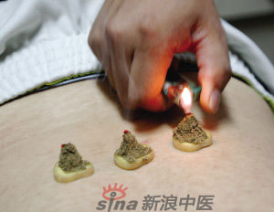 灸法的種類  你知道多少？